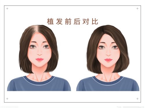 生孩子后掉头发很厉害怎么办 生完宝宝后掉头发原因